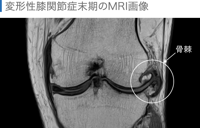 膝のMRI検査で何がわかる? 知っておきたいMRIとレントゲンの違い