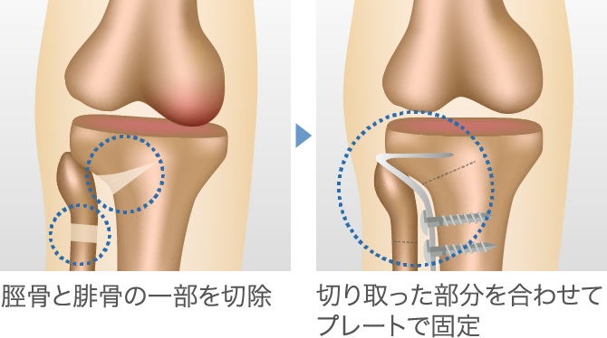 変形性膝関節症の手術【費用／タイミング／術後の入院期間】│ひざ関節症クリニック