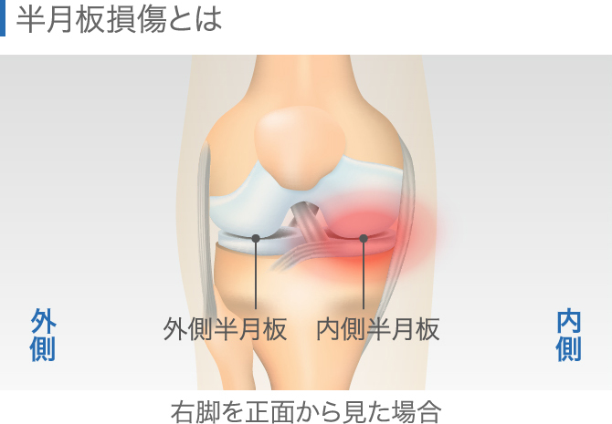 ひざの内側が痛いのはなぜ 原因となる病気や対処方法