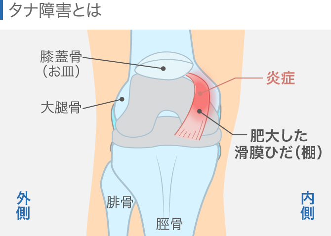 ひざの内側が痛いのはなぜ 原因となる病気や対処方法