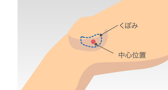 ひざの内側が痛いのはなぜ 原因となる病気や対処方法