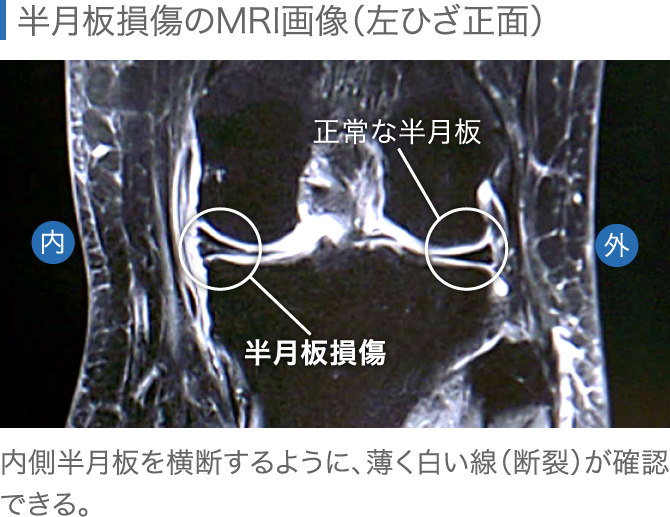 半月板損傷は自然治癒しない 有効な治療法を専門医が解説 ひざ関節症クリニック