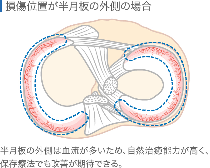 半月板損傷は自然治癒しない 有効な治療法を専門医が解説 ひざ関節症クリニック