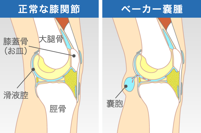 膝の裏が痛い原因や考えられる病気は ベーカー嚢腫や変形性膝関節症を解説 ひざ関節症クリニック