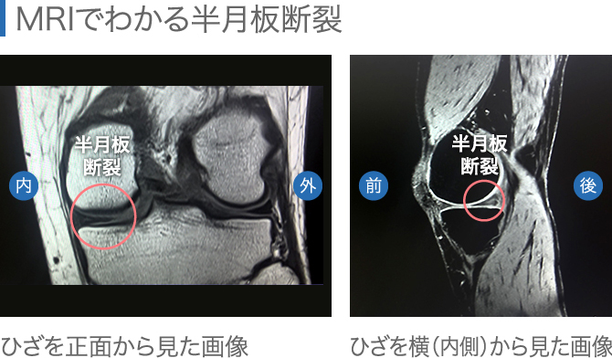 膝が腫れたらどうすべき 考えられる病気と原因別対処法