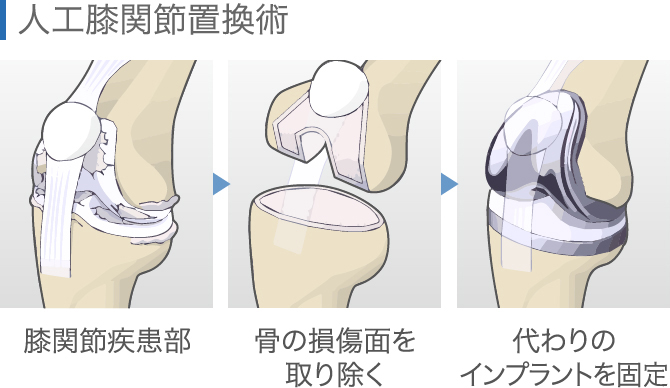 人工膝関節置換術の注意点 【禁忌、メリット・デメリット】│ひざ関節