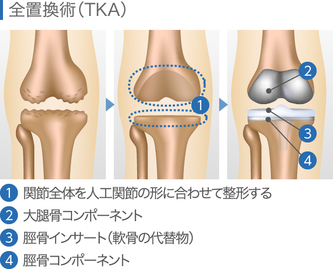 人工膝関節置換術の注意点 【禁忌、メリット・デメリット】│ひざ関節