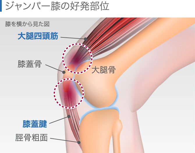 膝上が痛い原因はジャンパー膝以外にも セルフケアや治療法を全解説