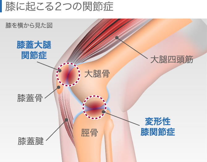 膝上が痛い原因はジャンパー膝以外にも セルフケアや治療法を全解説