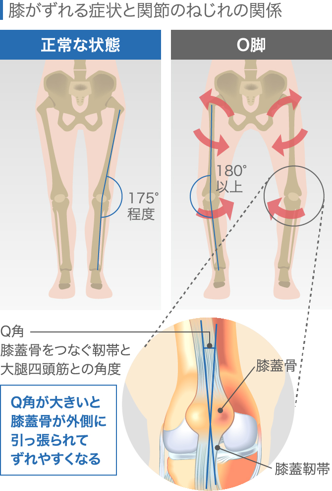 膝の違和感の症状チェック！痛くないけど気になる原因と対処法│ひざ関節症クリニック