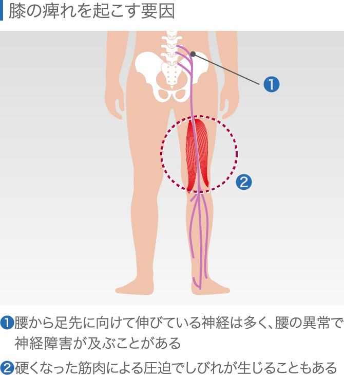 膝の違和感の症状チェック 痛くないけど気になる原因と対処法