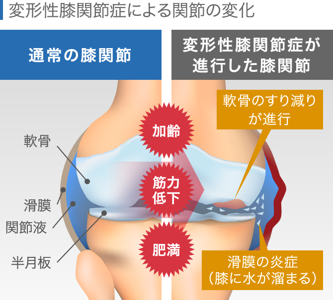 膝の違和感の症状チェック 痛くないけど気になる原因と対処法