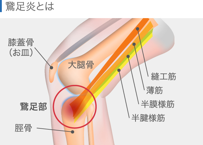 膝の痛みの原因を場所別に解説 内側 外側 膝上 膝下 ひざ裏