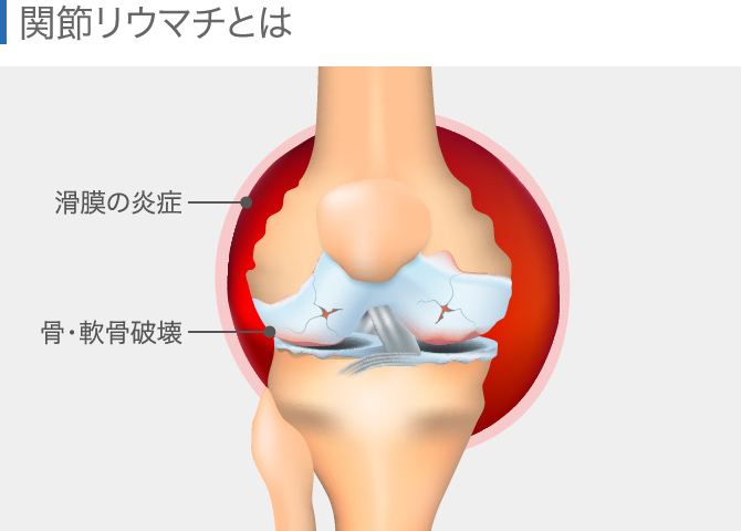 膝の痛みの場所でわかる！原因と対処法│ひざ関節症クリニック