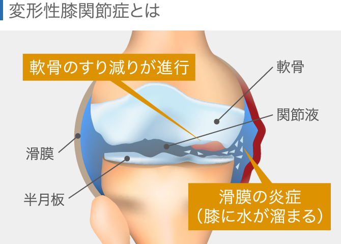 膝の痛みの場所でわかる！原因と対処法│ひざ関節症クリニック