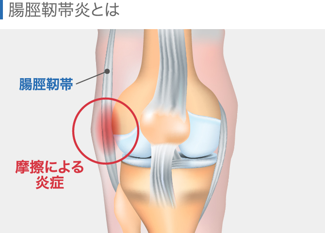 膝の痛みの原因を場所別に解説 内側 外側 膝上 膝下 ひざ裏