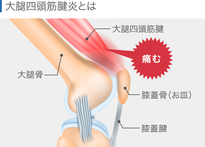 膝の痛みの原因を場所別に解説【内側・外側・膝上・膝下・ひざ裏】