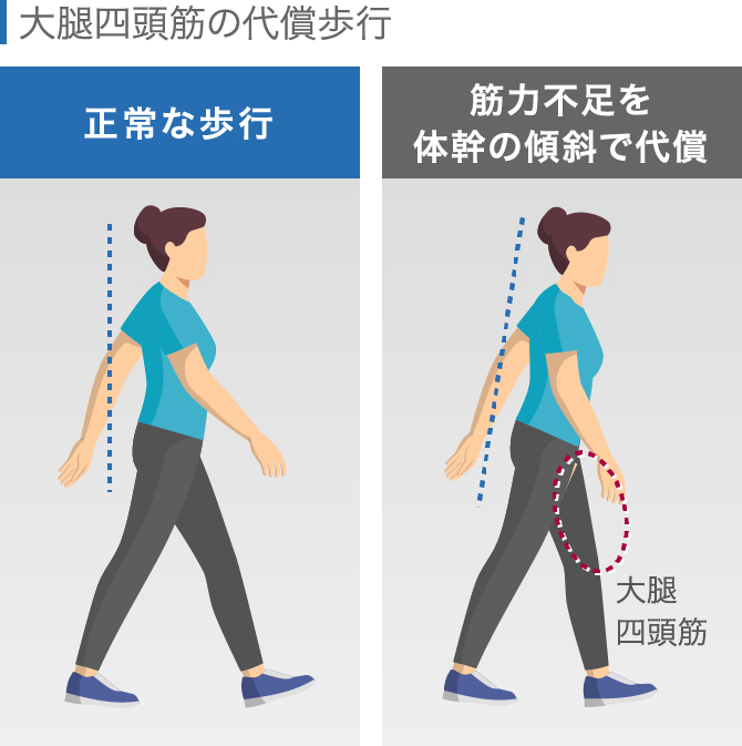 変形性膝関節症は予防できる? 【歩き方・筋トレ・食事】