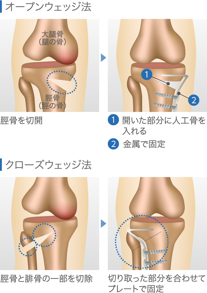 高位脛骨骨切り術｜後悔しないための基礎知識～方法・適応から再生医療