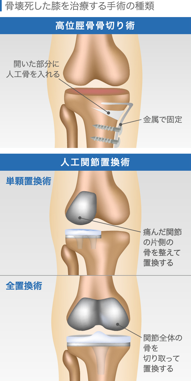 壊死した骨は治る？