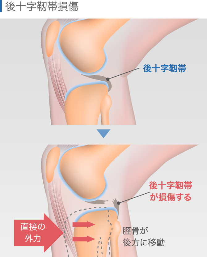 後十字靭帯損傷の放置は危険【症状・治療法・リハビリを解説】