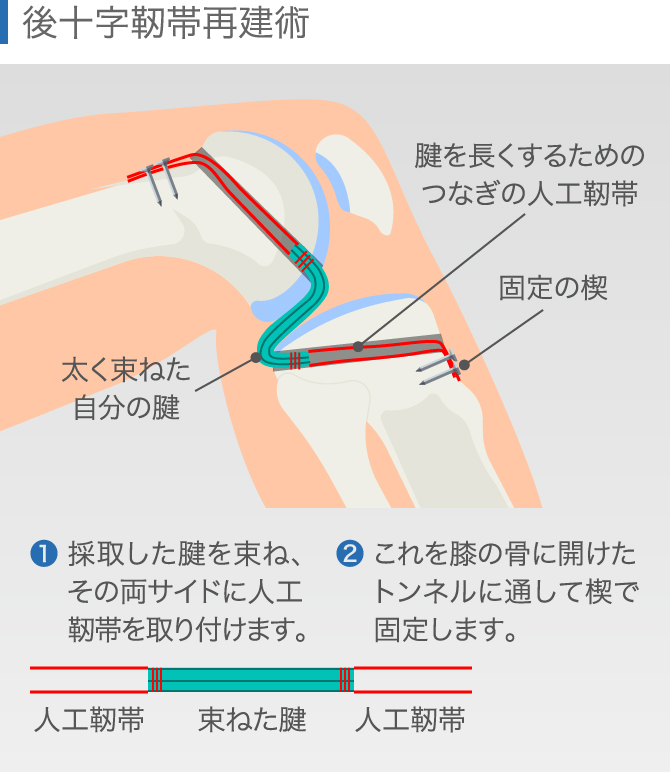 後十字靭帯損傷の放置は危険【症状・治療法・リハビリを解説】